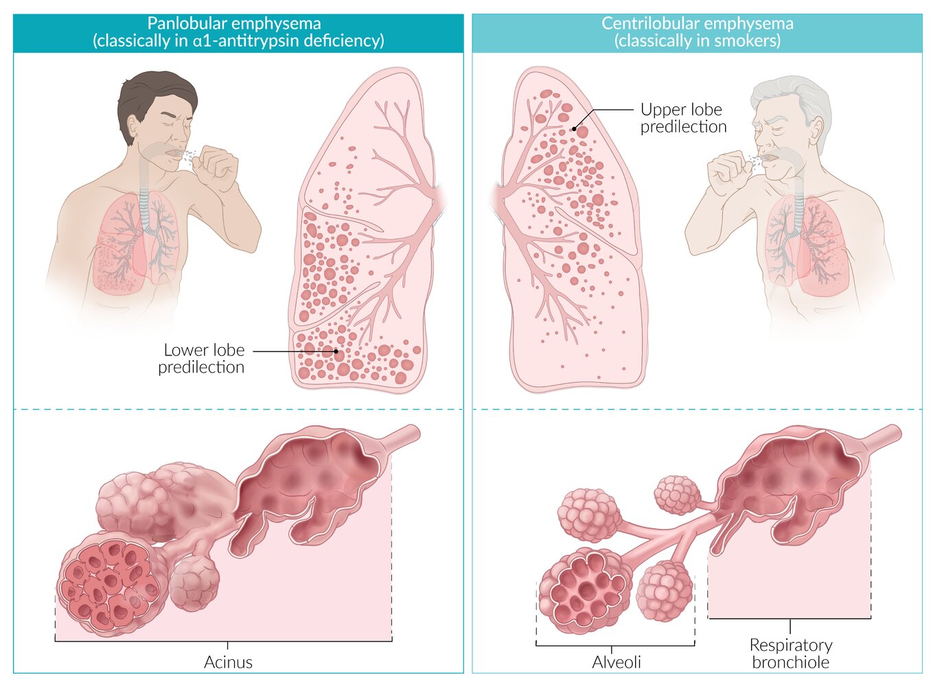 Targeted Treatments For Chronic Obstructive Pulmonary, 54% OFF