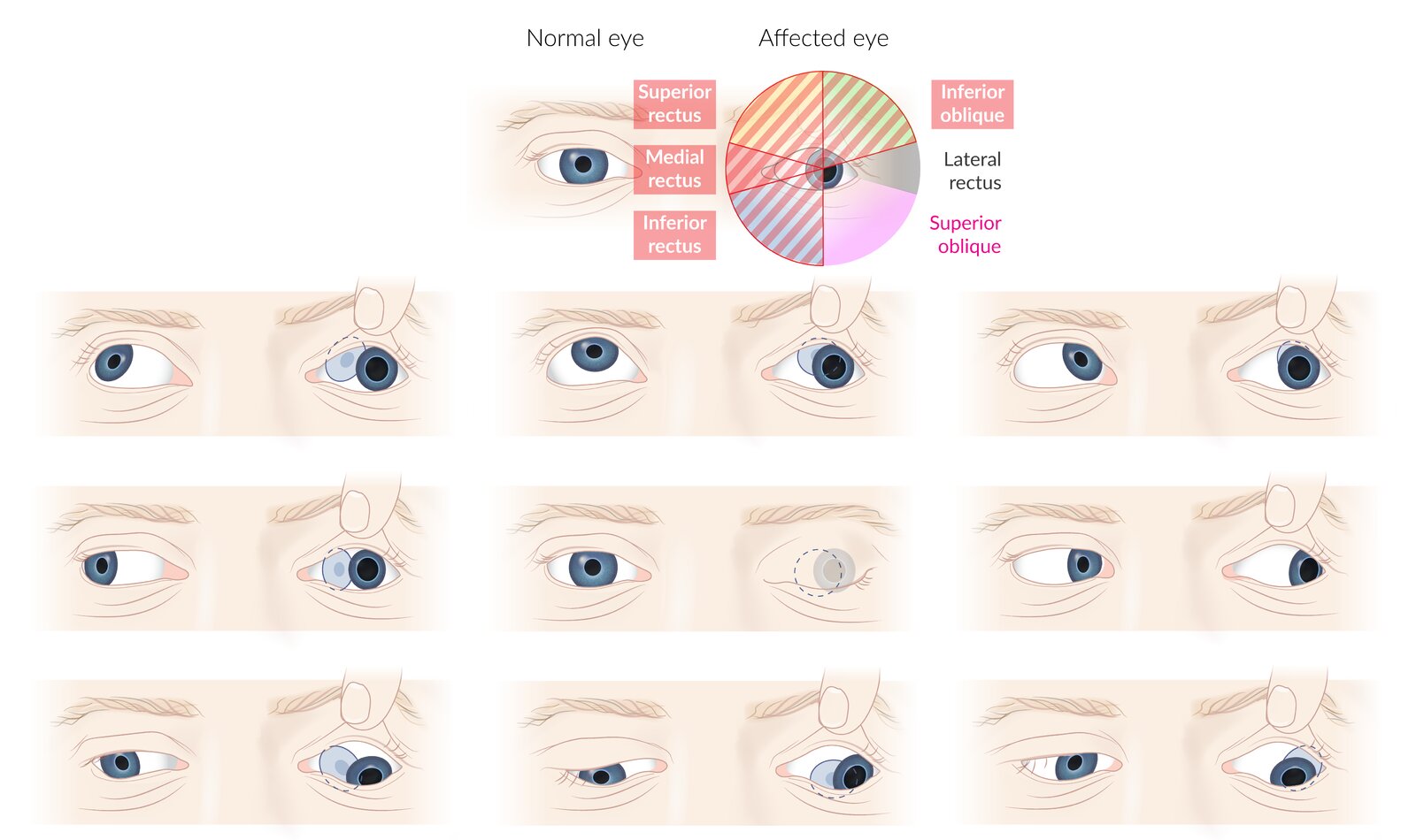 Cranial Nerve 6 Palsy