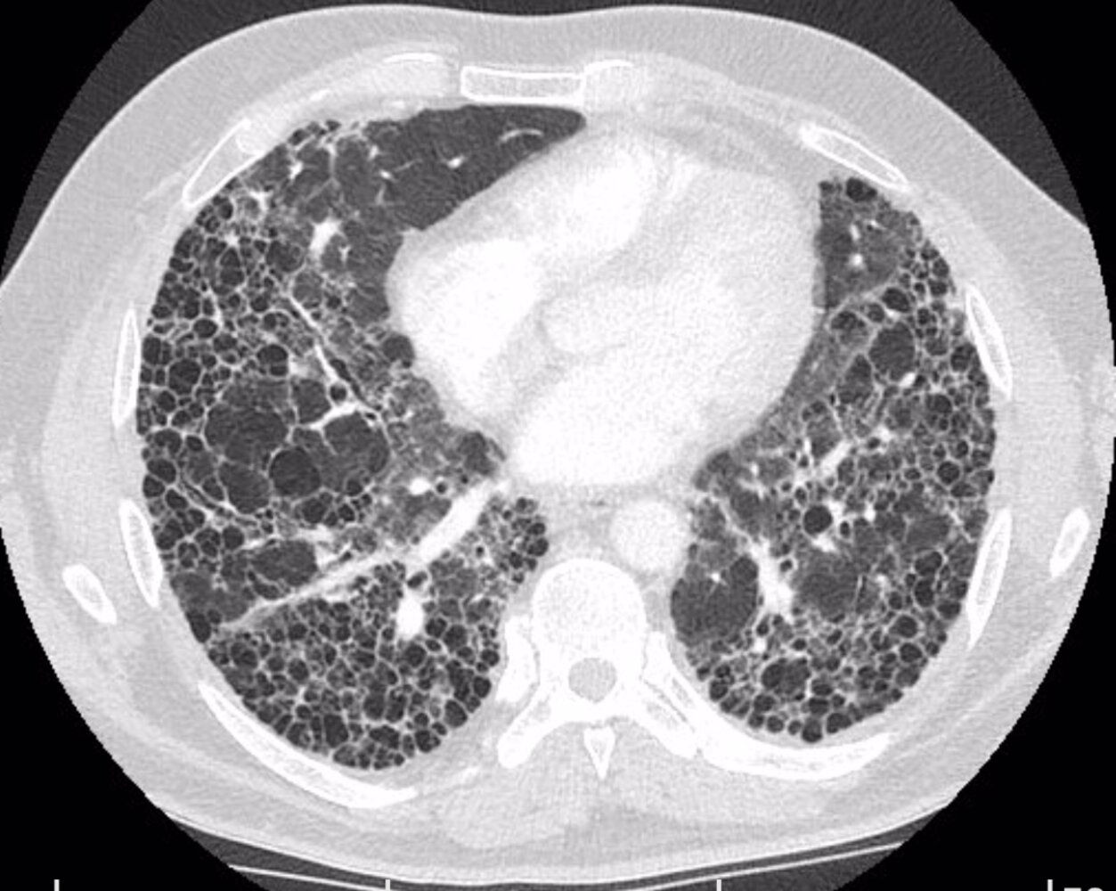 Idiopathic Pulmonary Fibrosis Honeycomb