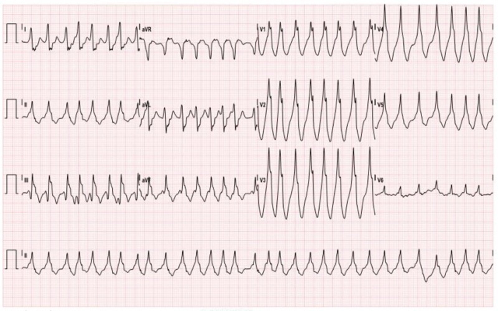 Atrial Fibrillation With Rapid Ventricular Rate ECG, 60% OFF