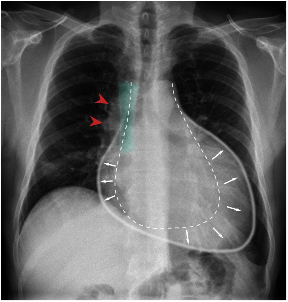 Pericardial Effusion And Cardiac Tamponade Knowledge AMBOSS, 53% OFF