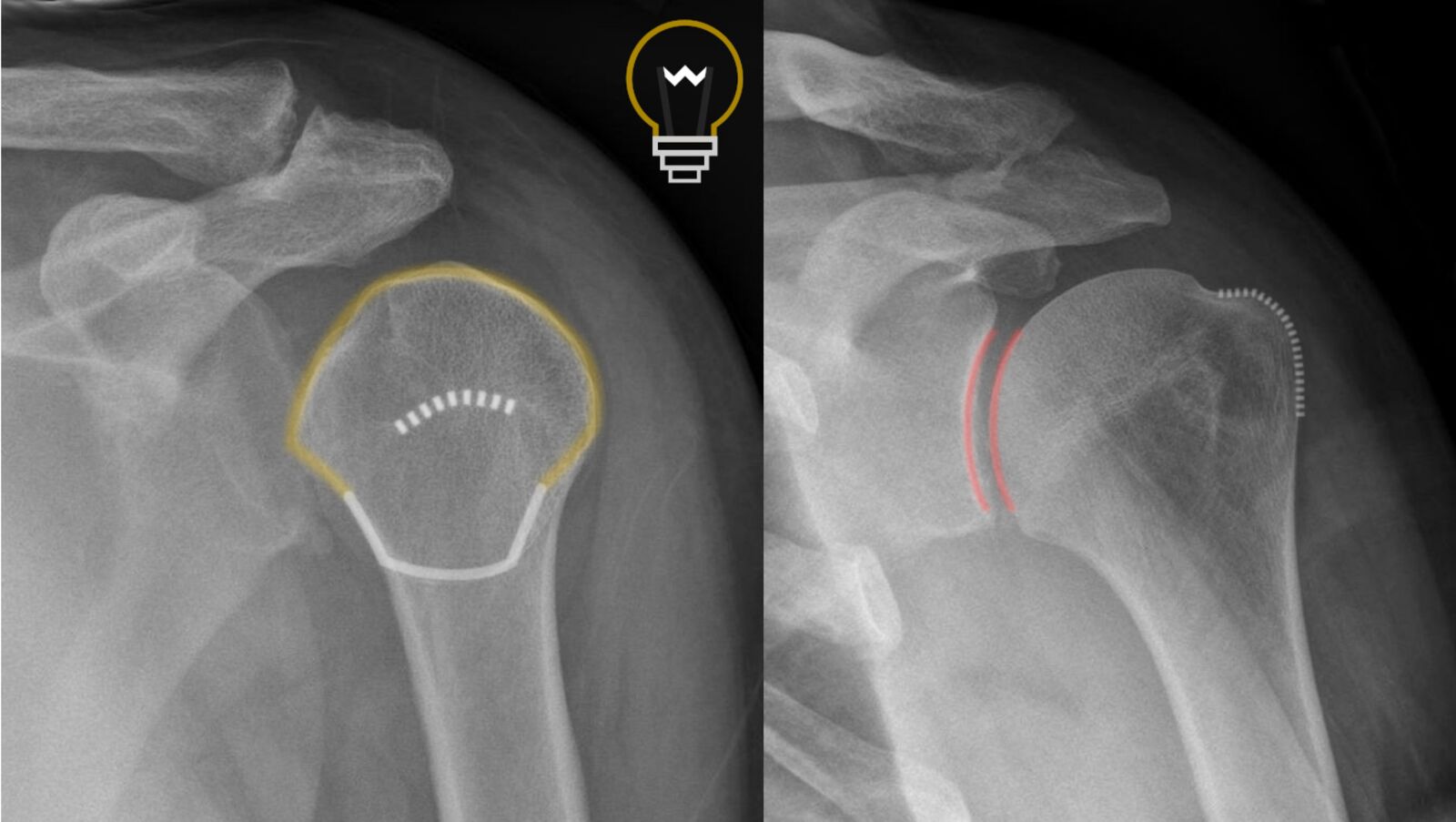 Mri Shoulder Dislocation