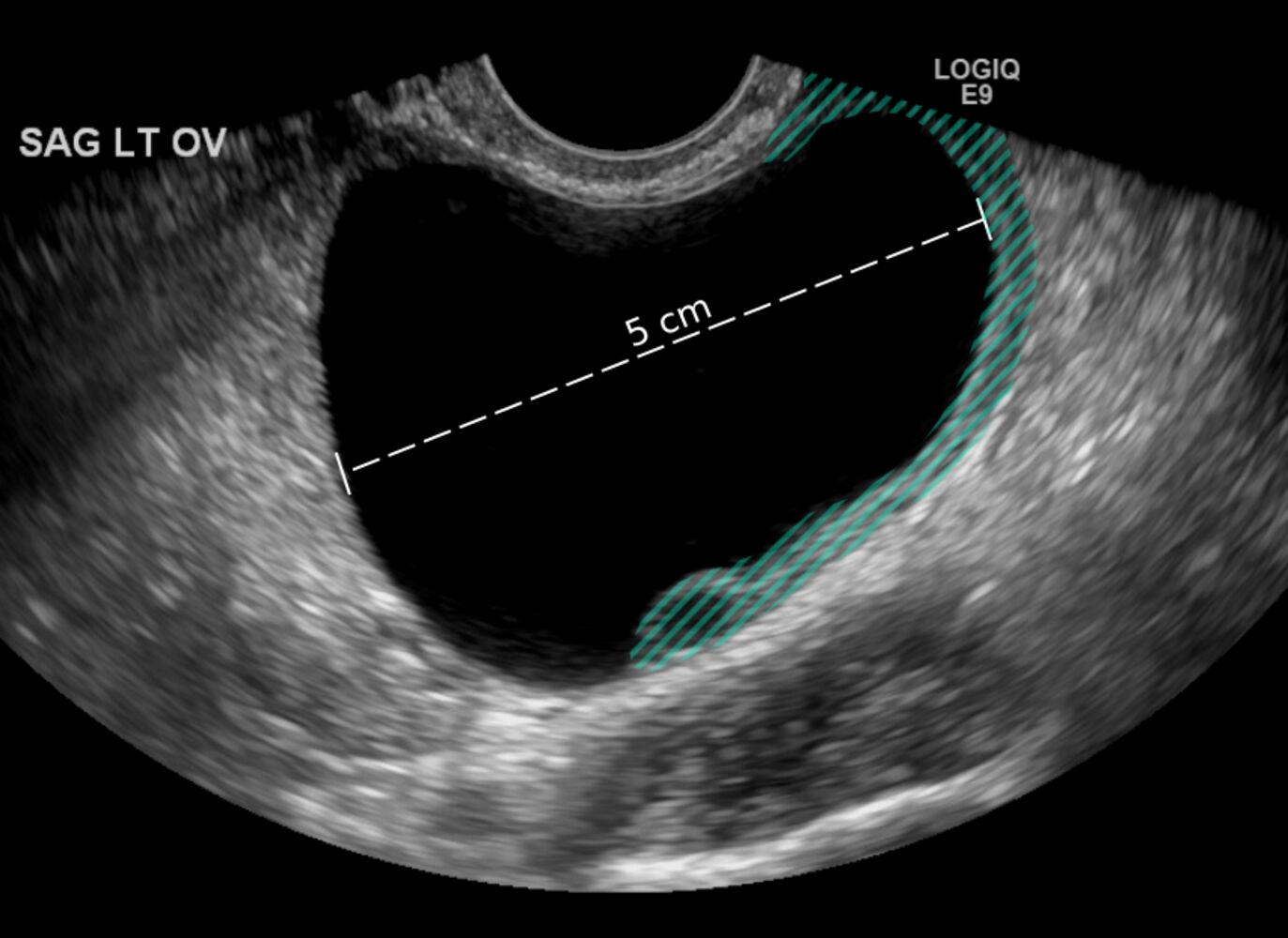 Ovarian Cyst And Pregnancy Ultrasound