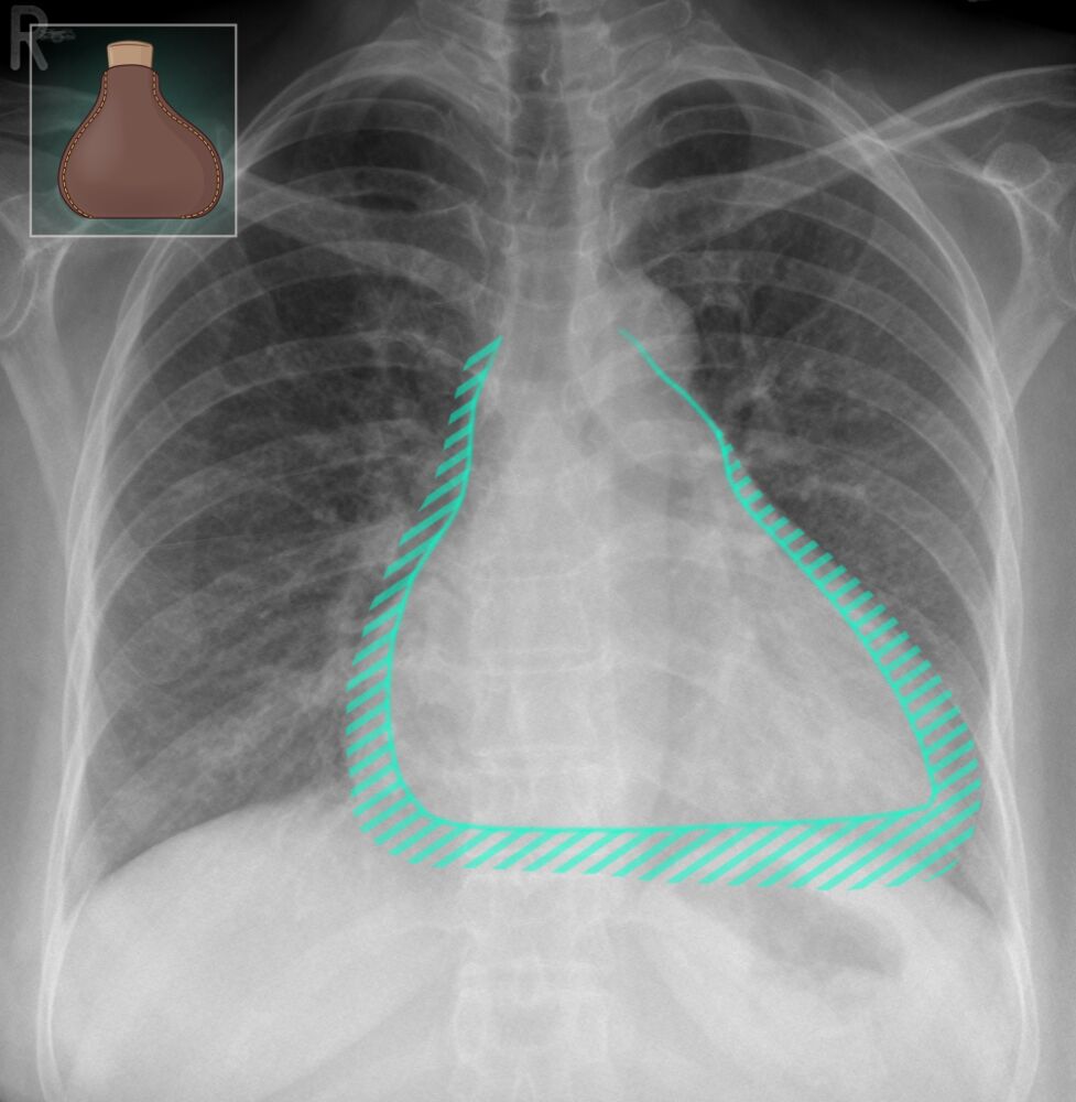 Cardiac Tamponade Pericardial Tamponade - vrogue.co