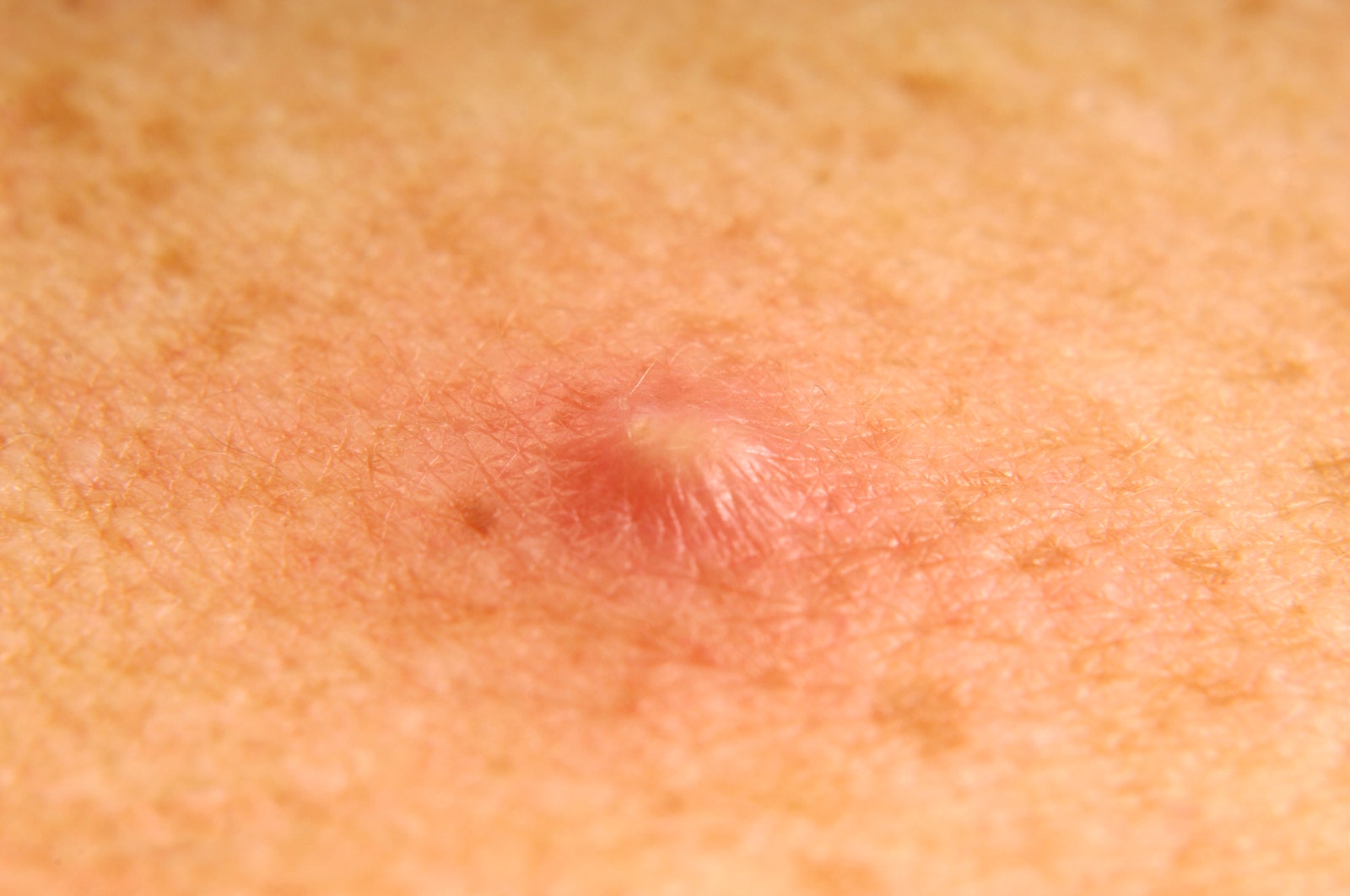 cystic pimple