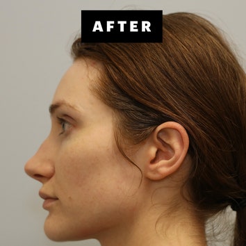 I Tried Forever Clear BBL Laser Treatment for My Chronic Acne