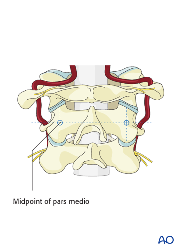 c2 pars screw insertion