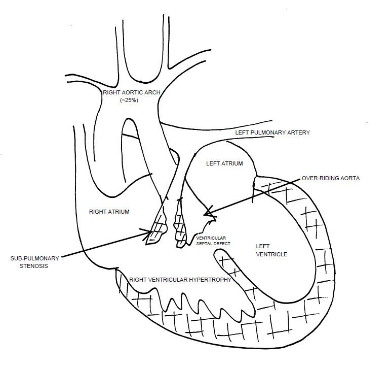 Tetralogy of Fallot - The Clinical Advisor