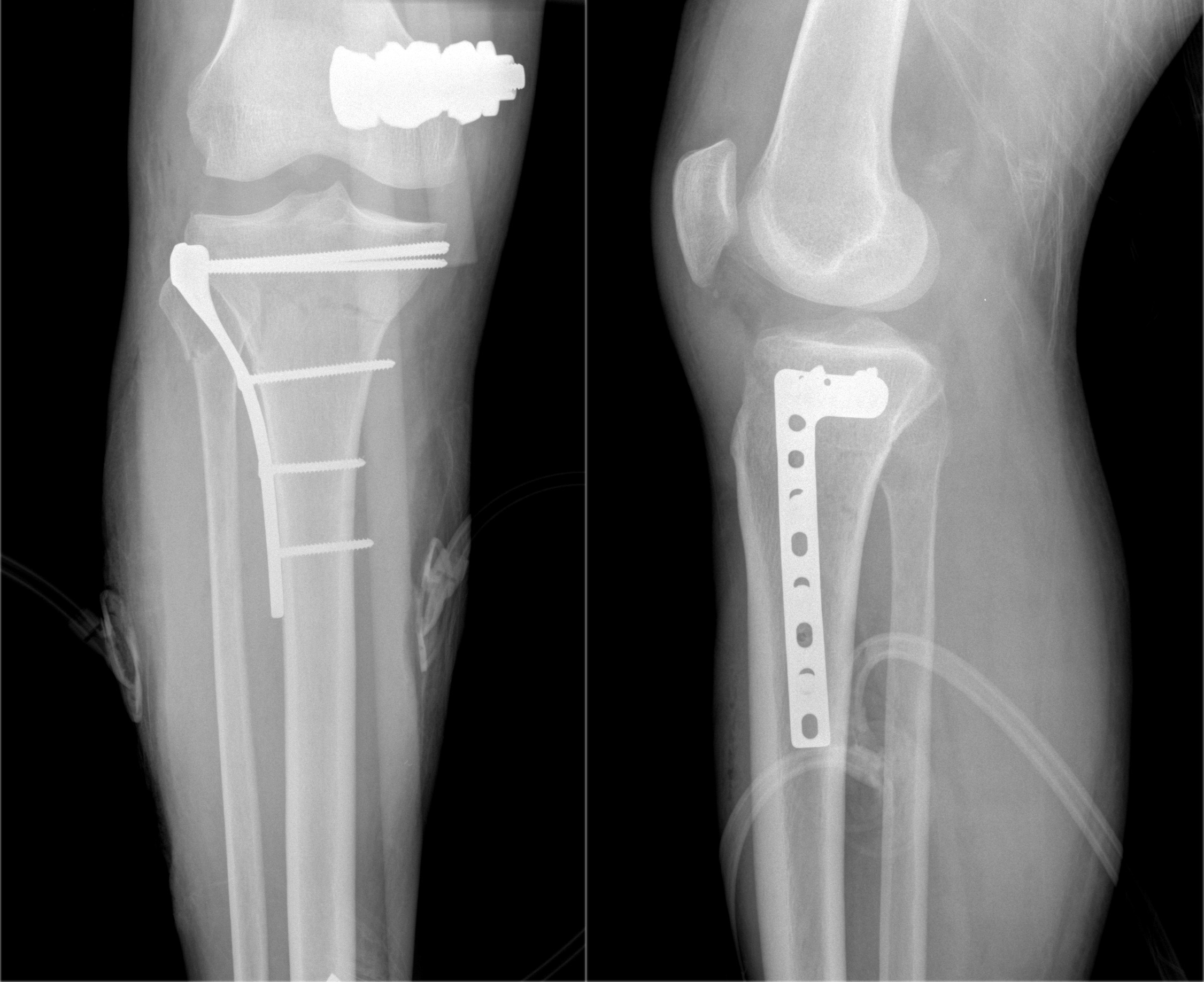 Tibial Plateau Fracture Internal Fixation Xrays | The Best Porn Website