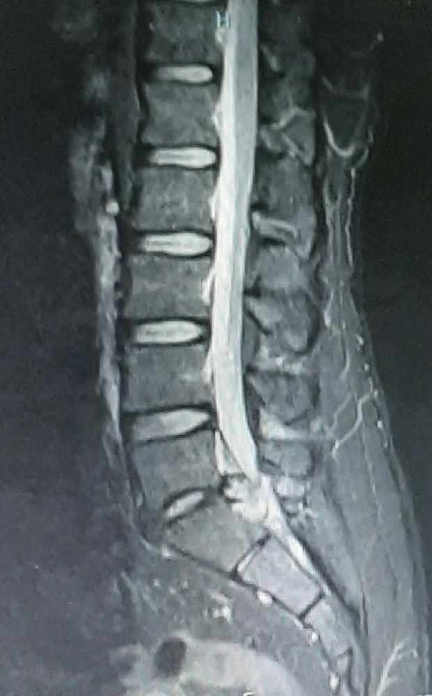 L 5- S1 IV disc ,with migration to S1 vertebral level