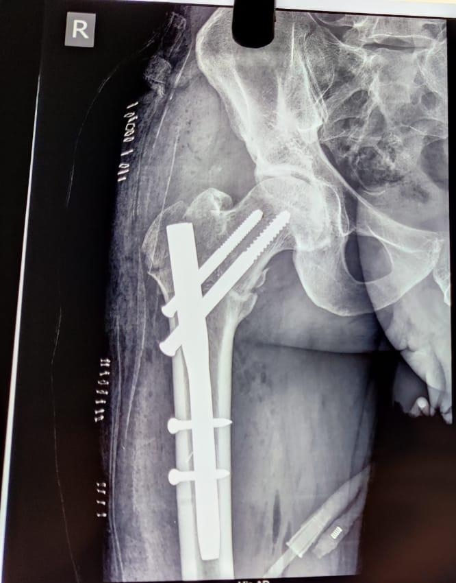 Intertrochanteric fracture