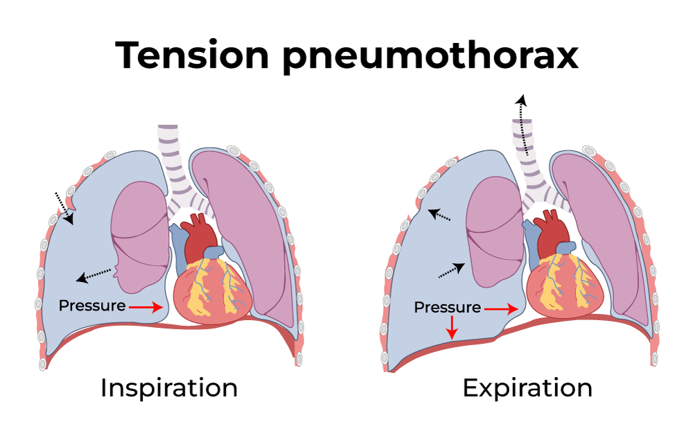 Tension Pneumothorax