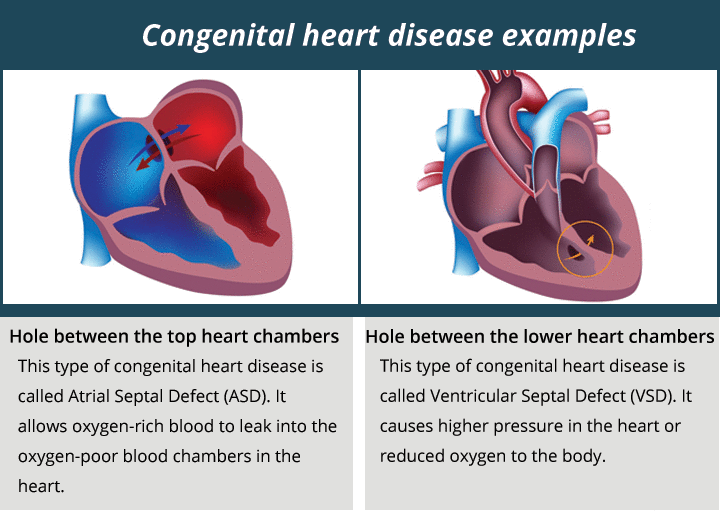 Understanding Congenital Heart Disease in Adults: Causes, Symptoms, and ...