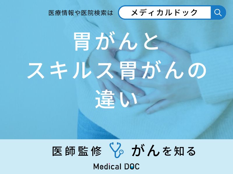 「胃がんとスキルス胃がんの違い」はご存知ですか？初期症状も医師が徹底解説！