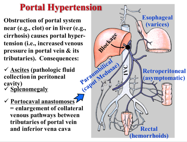 Paraumbilical Vein Caput Medusae