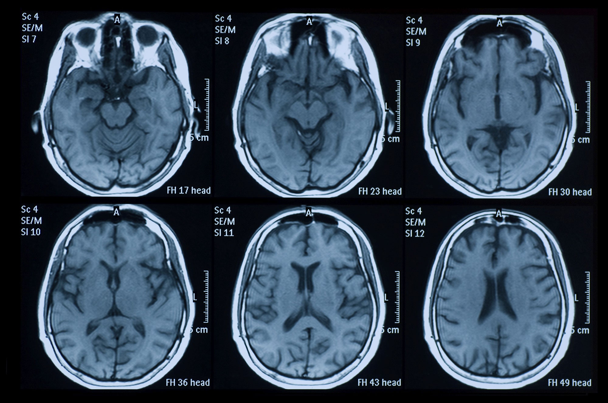 Traumatic Brain Injury Mri