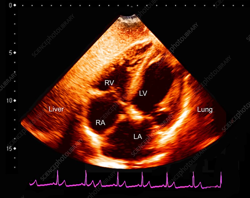 Normal heart, ultrasound scan - Stock Image - C048/0782 - Science Photo ...