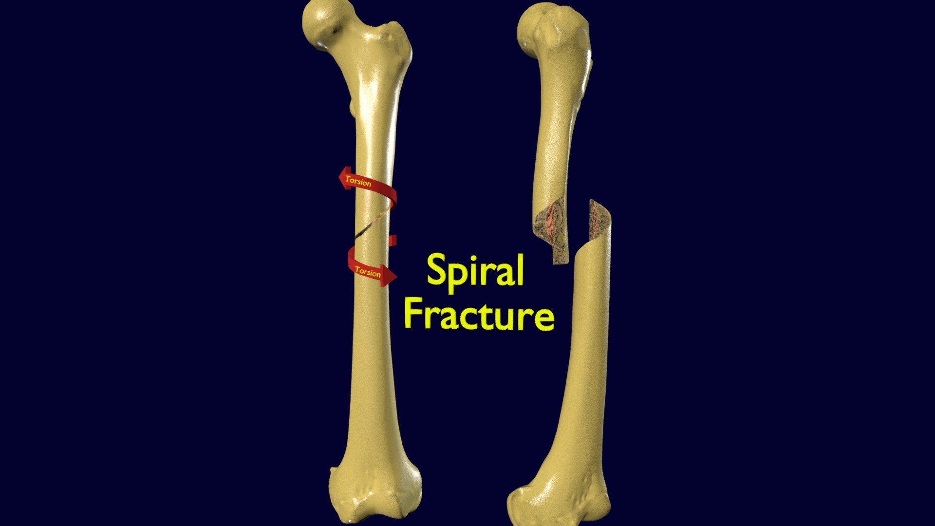 Types Of Femur Fractures