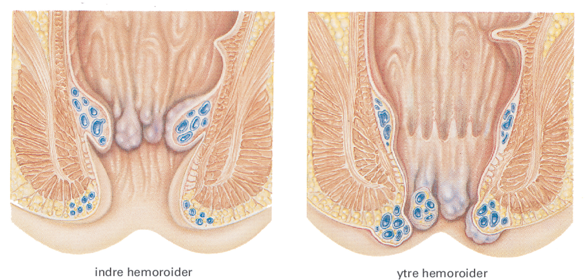 Hemoroide.