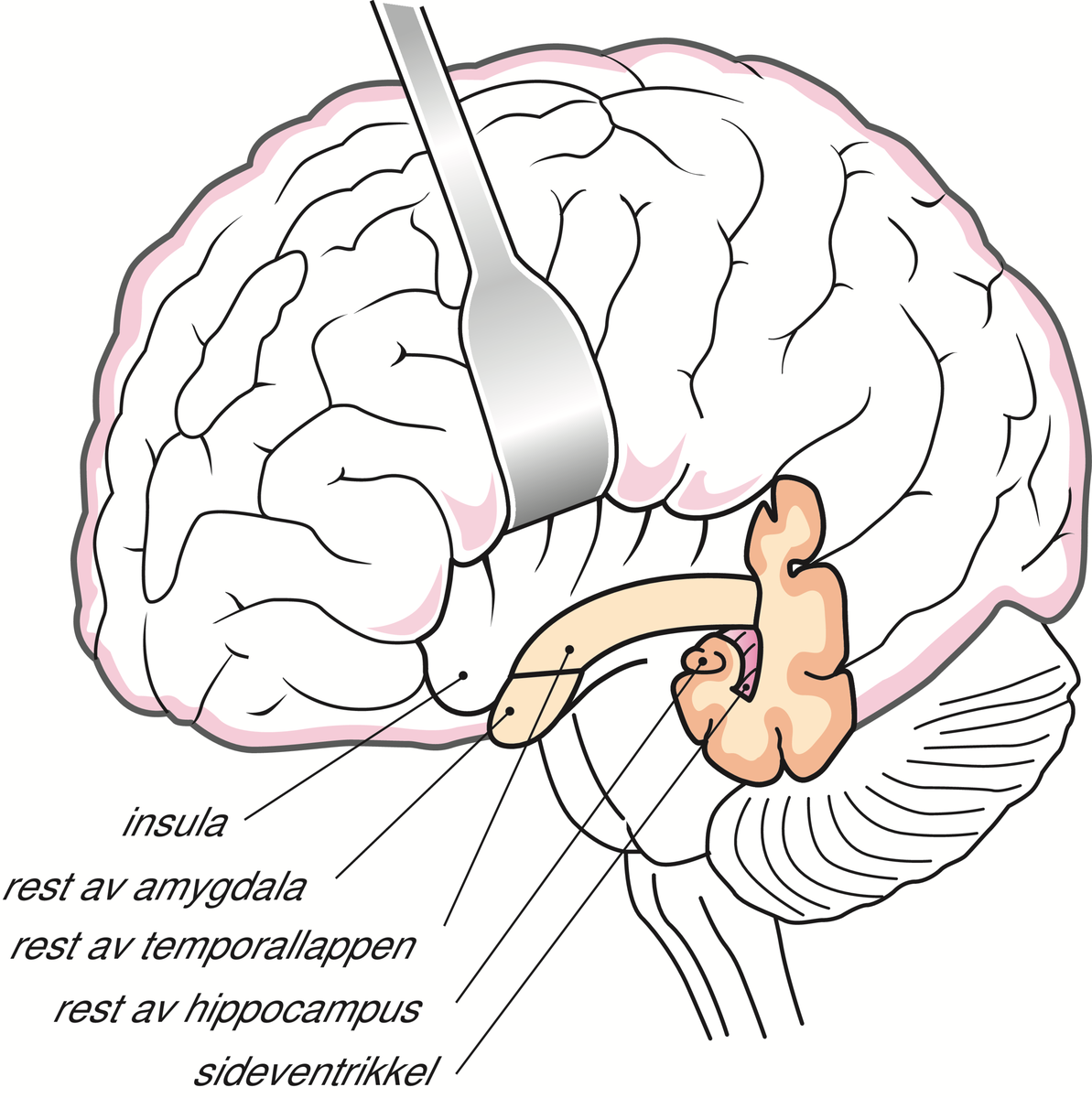 Epilepsi