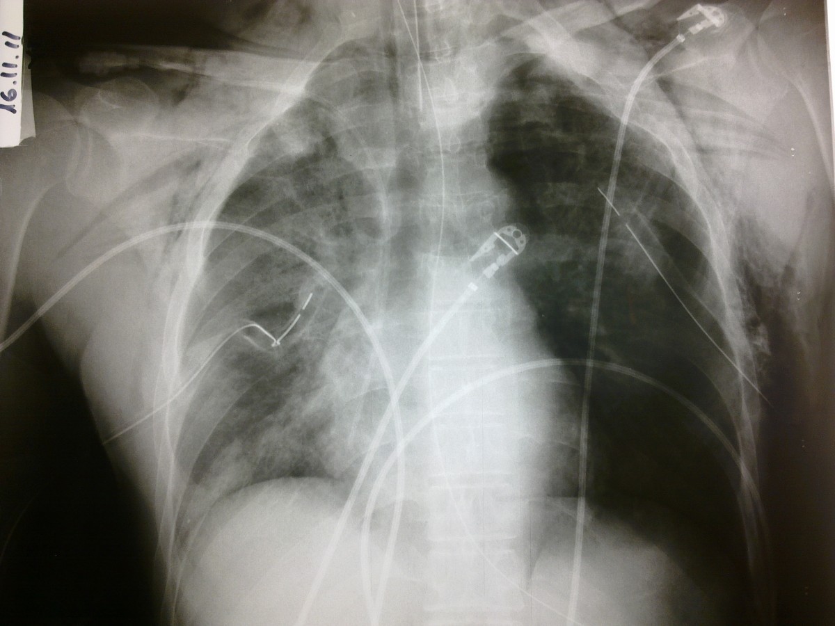 Traumatic asphyxia due to blunt chest trauma: a case report and ...