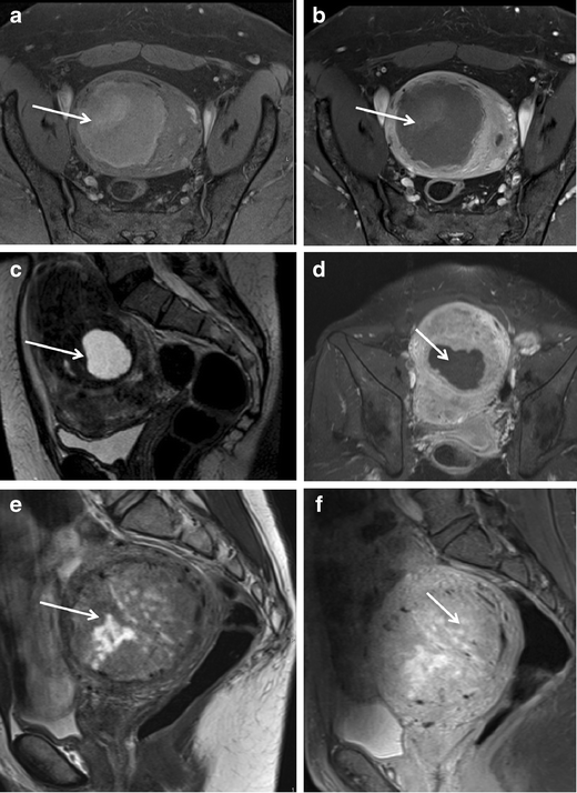 European Society of Urogenital Radiology (ESUR) Guidelines: MR Imaging ...