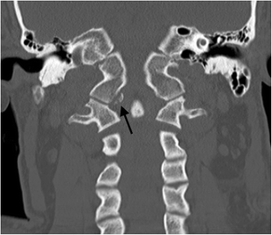 The craniocervical junction: embryology, anatomy, biomechanics and ...