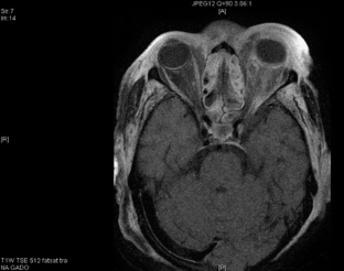 Craniofacial necrotizing fasciitis: reconstruction after radical ...