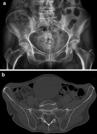 Low-energy osteoporotic pelvic fractures | SpringerLink