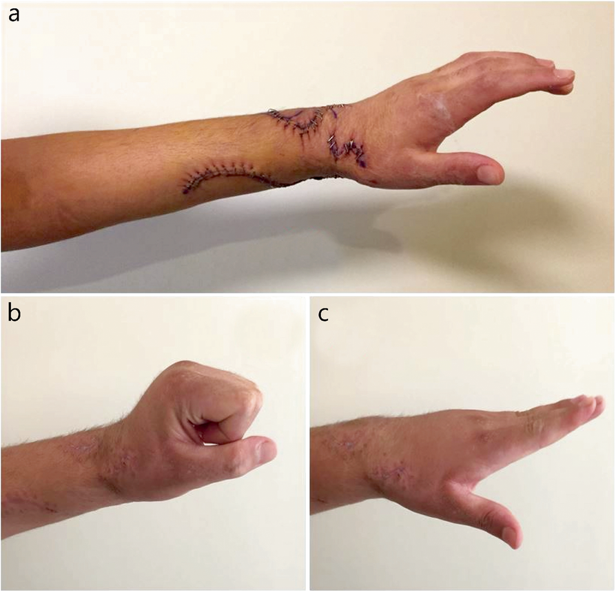 Surgical restoration of drop-hand syndrome with tendon transfer in ...