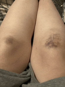 a woman 's knee has a bruise on it and a scar