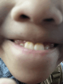 a close up of a person 's mouth with a few missing teeth