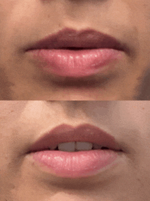 a close up of a woman 's lips before and after a procedure