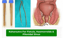 a poster for ksarsutra for fistula haemorrhoids & pilonidal sinus