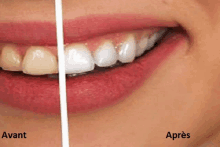 a before and after picture of a woman 's teeth in french .