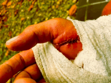 a person 's hand is wrapped in a bandage and has a stitch on it