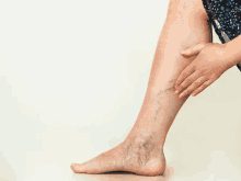 a woman has varicose veins on her leg and is holding her leg