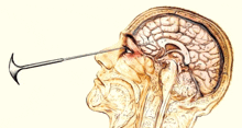 a drawing of a human head with a needle in it