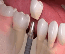 a close up of a person 's teeth with a dental implant .