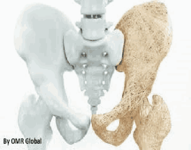 a model of a pelvis with a healthy pelvis and a damaged pelvis .