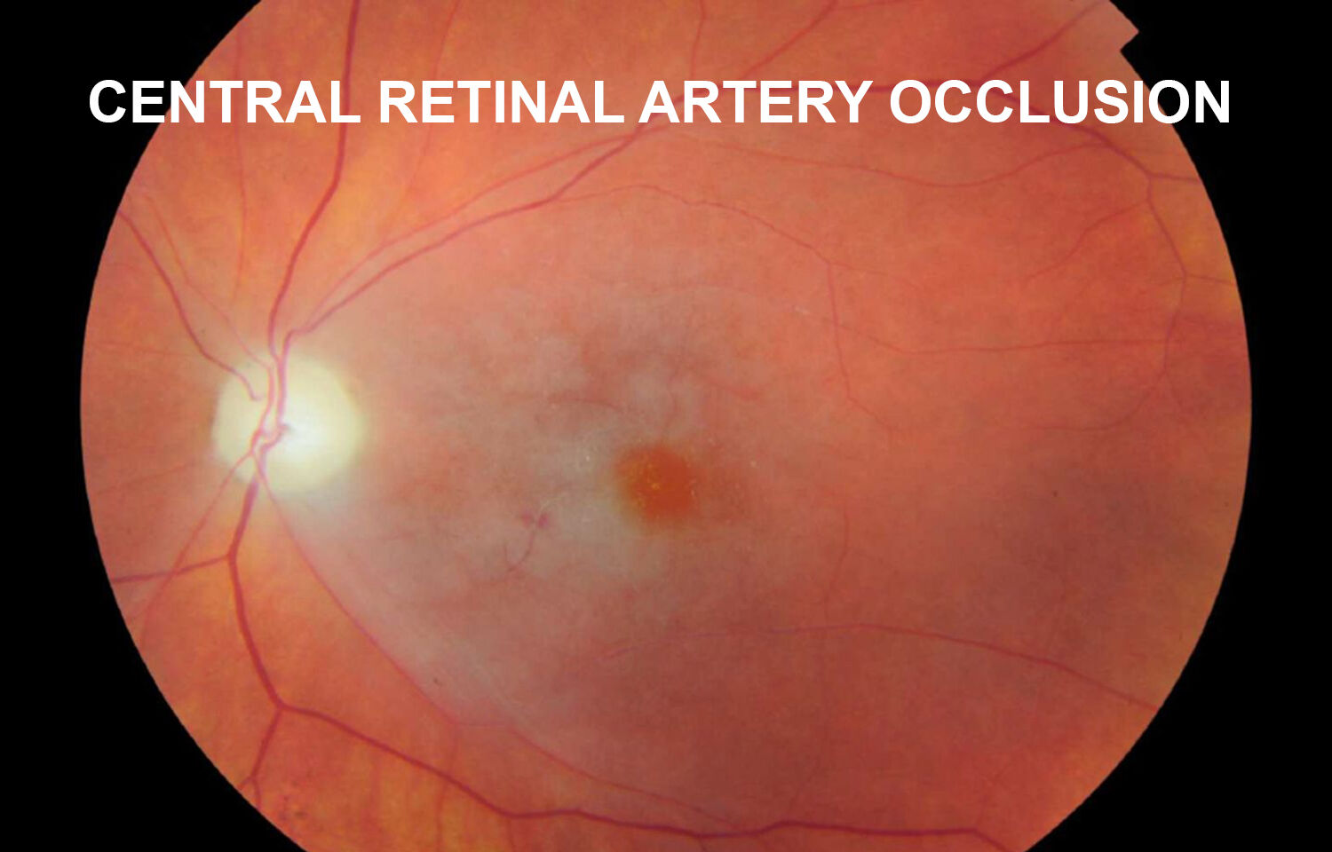 Management of Central Retinal Artery Occlusion: Scientific Statement ...