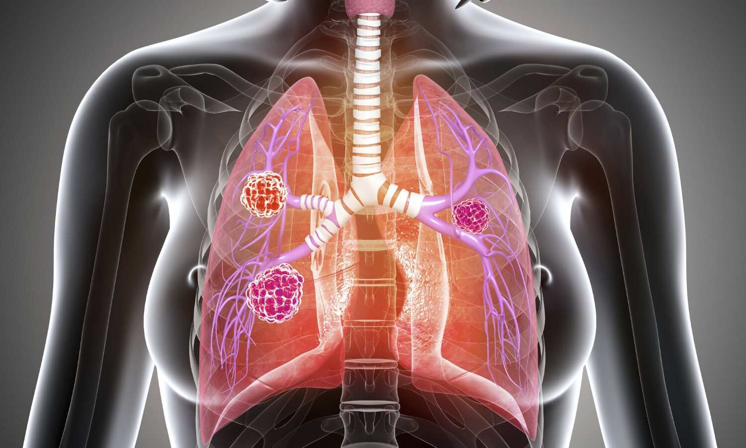 Ringlike peripheral high iodine concentration can differentiate lung ...