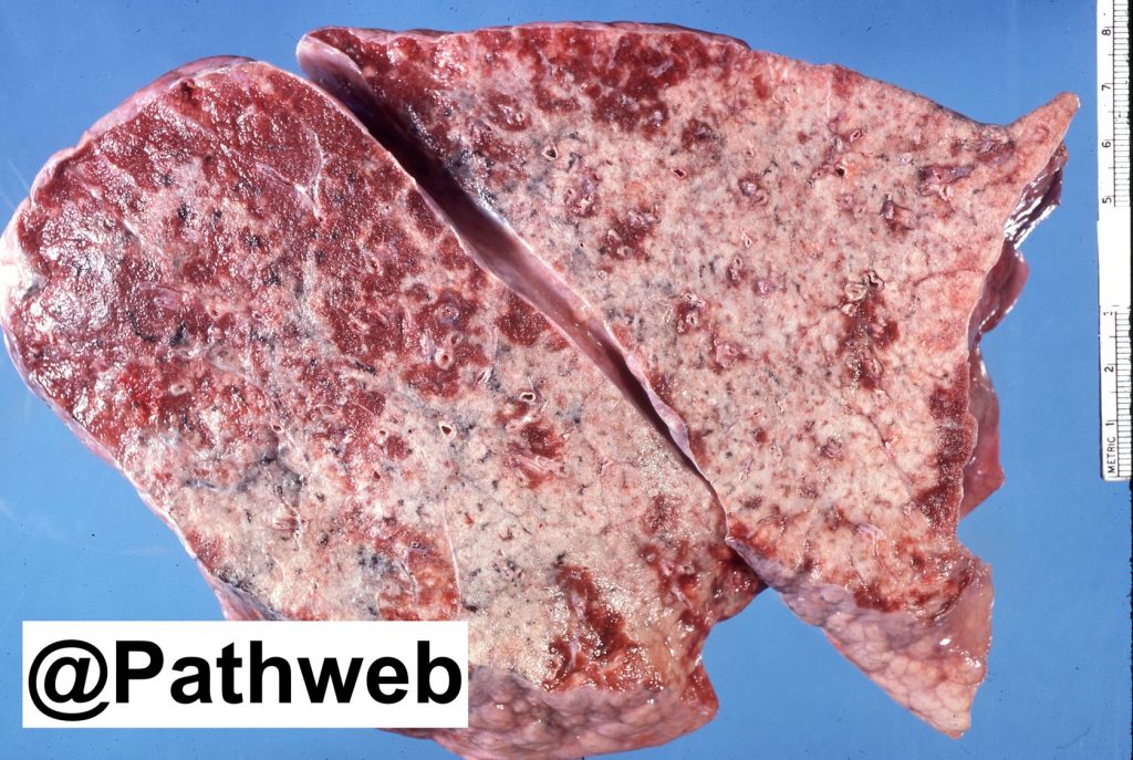 Lung Lobar Pneumonia – NUS Pathweb :: NUS Pathweb