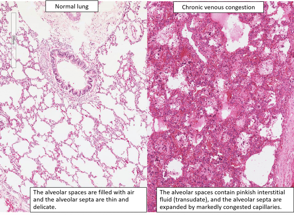 Chronic Venous Congestion Cvc Liver Cvc Lung Cvc Spleen Pathology ...