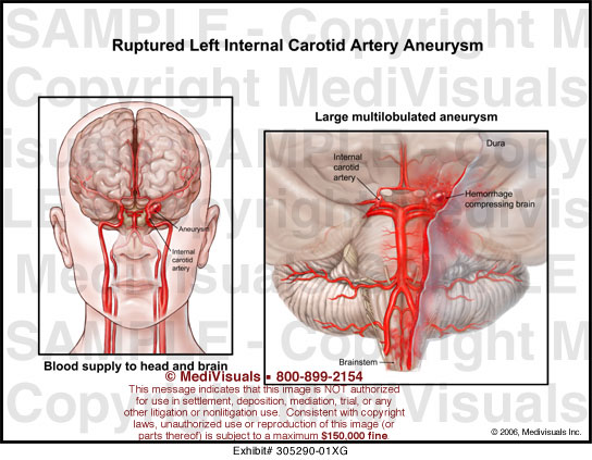 Medivisuals Ruptured Left Internal Carotid Artery Aneurysm Medical ...