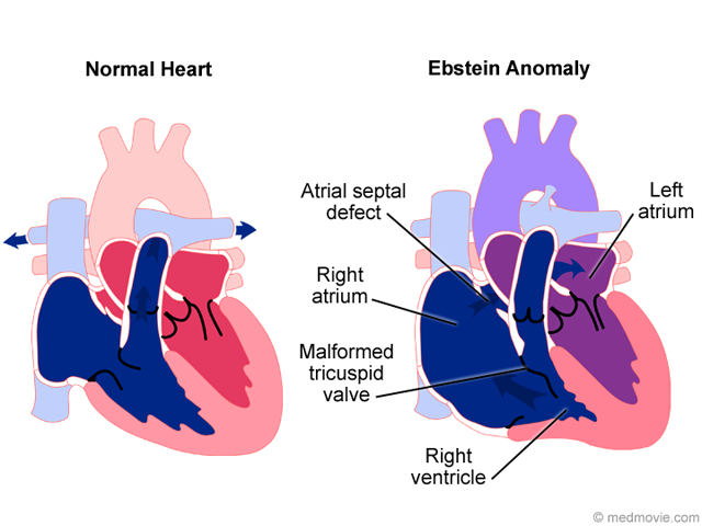 Ebstein Anomaly