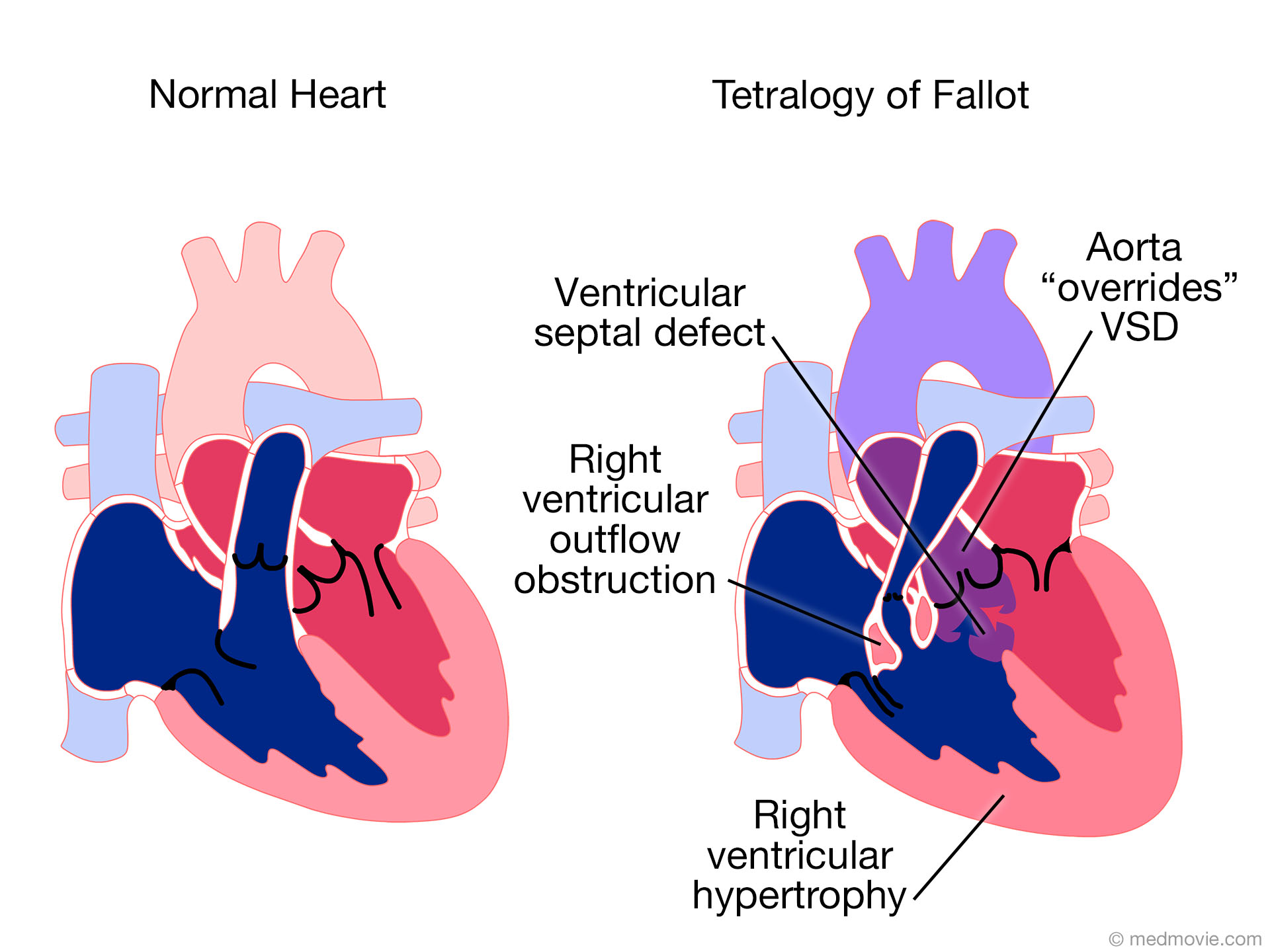 Single Ventricle