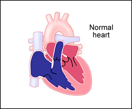 Tricuspid Atresia