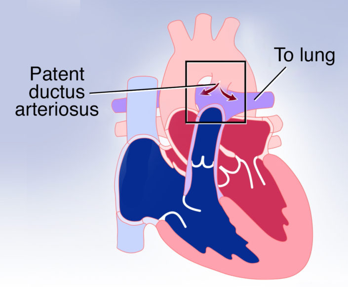 Patent Ductus Arteriosus