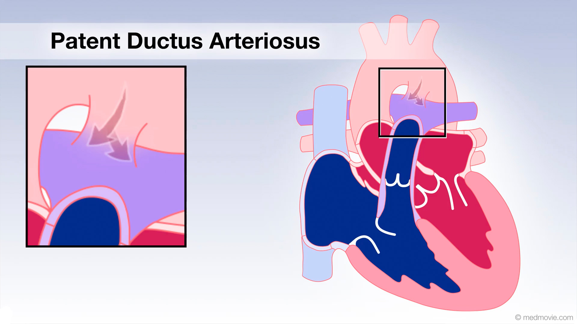 Patent Ductus Arteriosus Animation